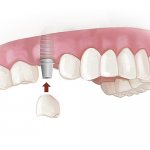 upper teeth prosthetics