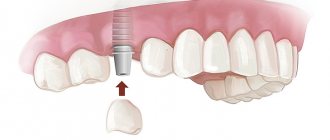 upper teeth prosthetics