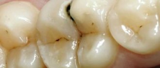 Pulpitis as a consequence of caries