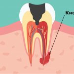 location of the dental cyst