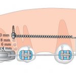 size of orthodontic mini implants