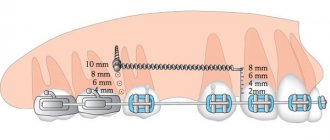 size of orthodontic mini implants