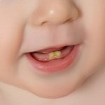 Child 1 year old, yellow plaque on teeth