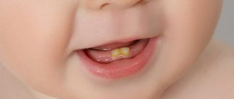 Child 1 year old, yellow plaque on teeth