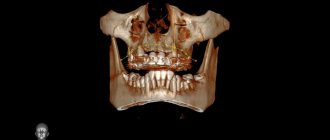 X-ray of the sinuses