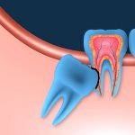 Retention of wisdom teeth