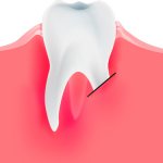 result of tooth root resection