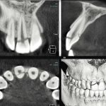 Rice. 1. CT, visualization of tooth 11, MPR; fracture within the enamel, dentin and pulp. 