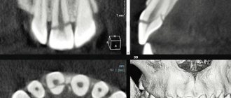 Rice. 1. CT, visualization of tooth 11, MPR; fracture within the enamel, dentin and pulp. 