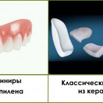 Съемные виниры на зубы