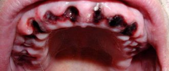 Blood clot after tooth extraction