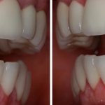 gaps between teeth