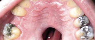 Syphilis on the palate