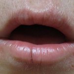 Symptoms of cheilitis in adults