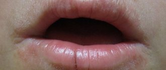 Symptoms of cheilitis in adults