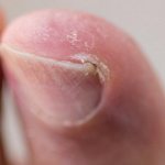 Симптомы вросшего ногтя
