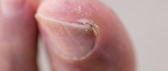 Symptoms of an ingrown toenail