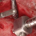 Sinus lift using osteotomy technique: possibilities for subsequent implantation