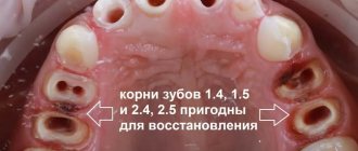 crowns were removed, inlays were removed and carious tissue was removed from teeth 4 and 5