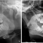 Comparison of X-ray and CT images