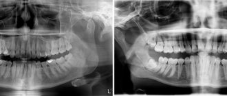 Comparison of X-ray and CT images