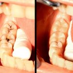 Medium caries: diagnosis and treatment