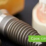 срок службы имплантов зубов