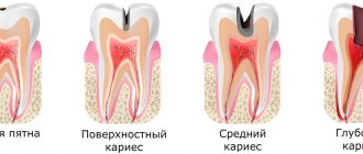 Stages of caries