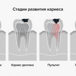 Стадии развития кариеса в картинках