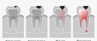 Stages of caries development in pictures