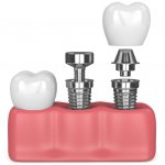 Structure of a dental implant