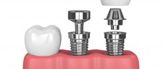 Structure of a dental implant