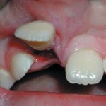 Front tooth injury