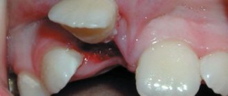 Front tooth injury