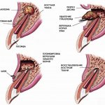 Removal of tooth granuloma in pictures