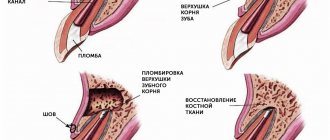 Removal of tooth granuloma in pictures