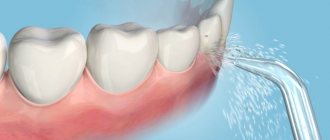 removing food from the mezdental spaces with an irrigator