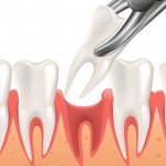 Removal of a tooth