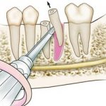 &#39;Removal of dental fragments - Dentistry &quot;Line of Smile&quot;&#39; width= &quot;400