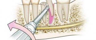 &#39;Removal of dental fragments - Dentistry &quot;Line of Smile&quot;&#39; width= &quot;400