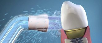 Implant care