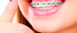 Installation of braces PHOTO