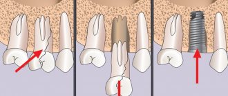 Implant installation