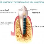 Installation of implants step by step