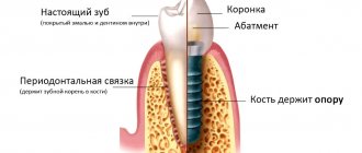 Установка имплантов пошагово