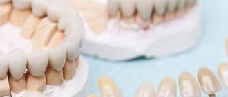 Installation of fixed dentures