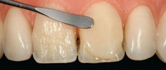 installation of direct veneers