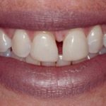 Installation of veneers