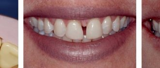 Installation of veneers