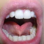 Tongue frenulum